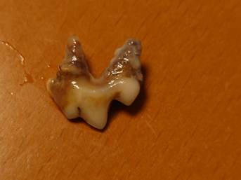 歯2